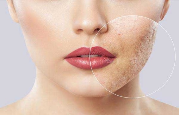 روتین مراقبتی پوست چرب و جوش دار در پامیشا