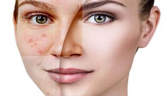 روغن بادام و خواص درمانی آن برای لک پوستی