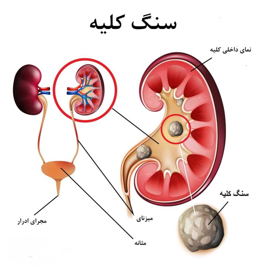 دفع سنگ کلیه با انجام حرکات ورزشی در پامیشا