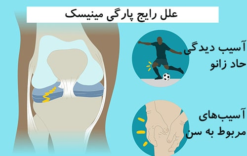 چگونه آسیب مینیسک زانو را درمان کنیم؟ در پامیشا