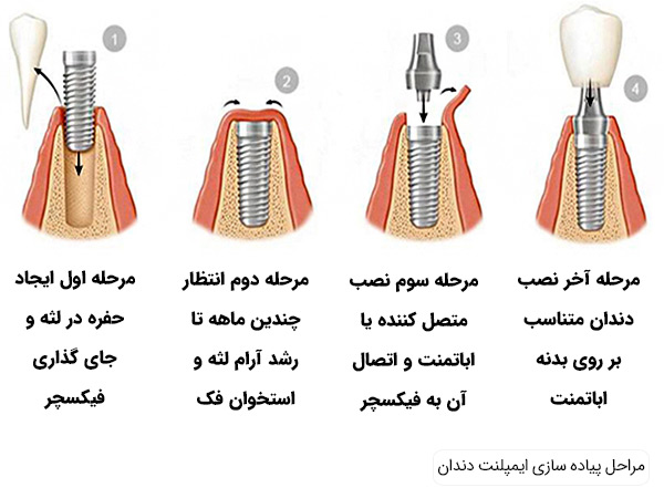 ایمپلنت دندان راهی بسوی سلامتی و زیبایی در پامیشا
