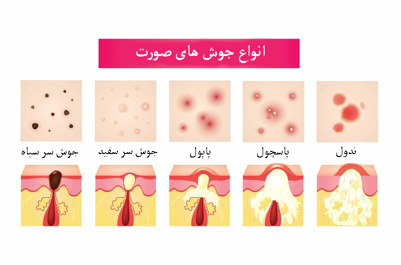 دلایل جوش چانه و معرفی درمان خانگی آن در پامیشا