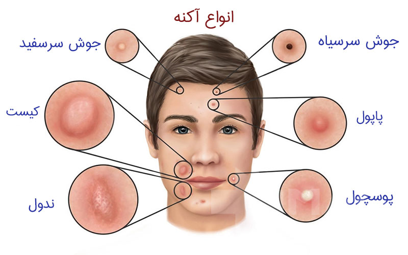 دلایل جوش چانه و معرفی درمان خانگی آن در پامیشا