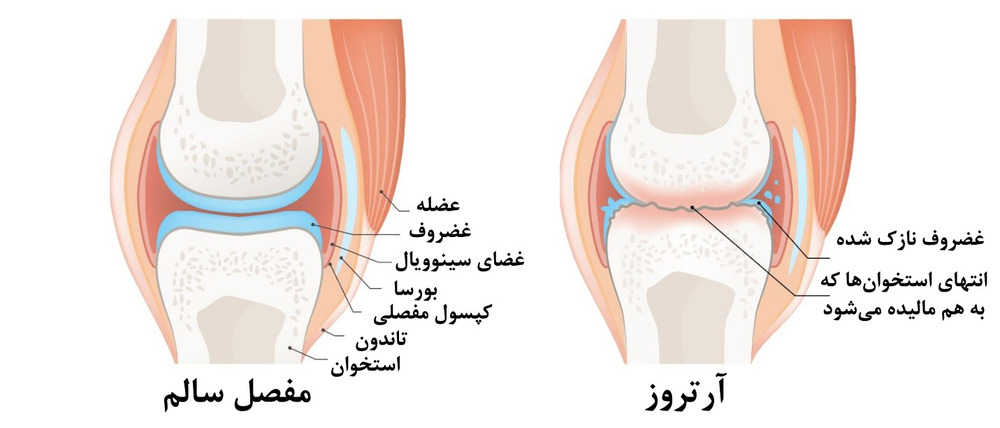 معرفی روش های پیشگیری از آرتروز زانو در پامیشا