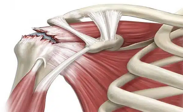 آسیب های ورزشی فقط مخصوص حرکات ورزشی است؟ در پامیشا