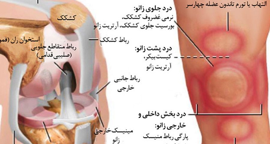 آسیب های ورزشی فقط مخصوص حرکات ورزشی است؟ در پامیشا