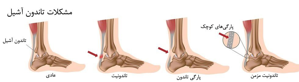 پارگی تاندون آشیل ، علائم و درمان آن در پامیشا