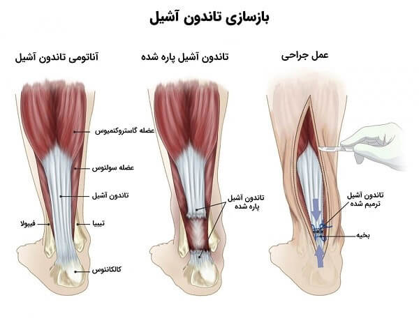 پارگی تاندون آشیل ، علائم و درمان آن در پامیشا