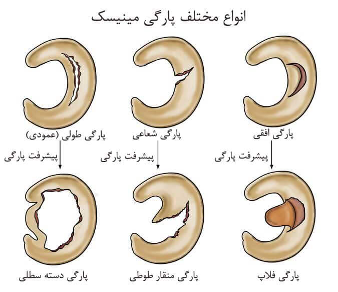 چگونه آسیب مینیسک زانو را درمان کنیم؟ در پامیشا