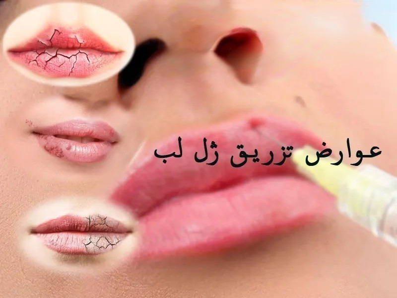 هشدار علمی و بهداشتی در خصوص عوارض تزریق ژل لب در پامیشا