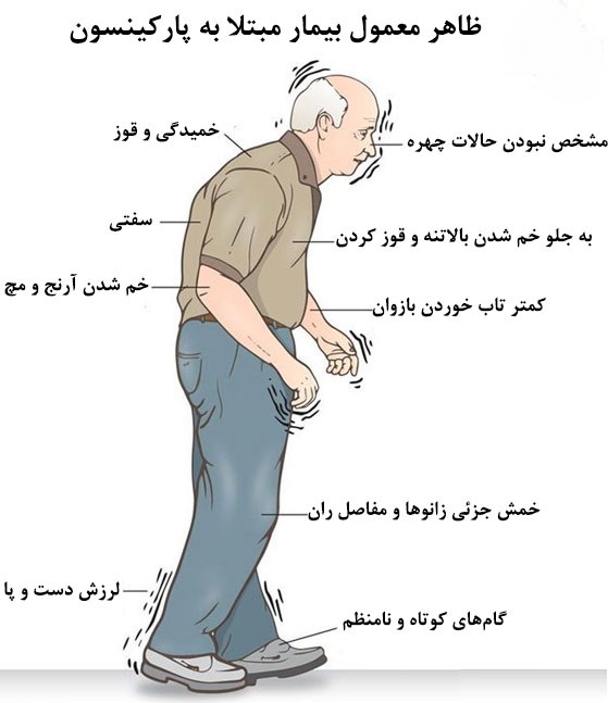 بیماری پارکینسون؛ نشانه‌ها، علائم، پیشگیری و درمان آن در پامیشا
