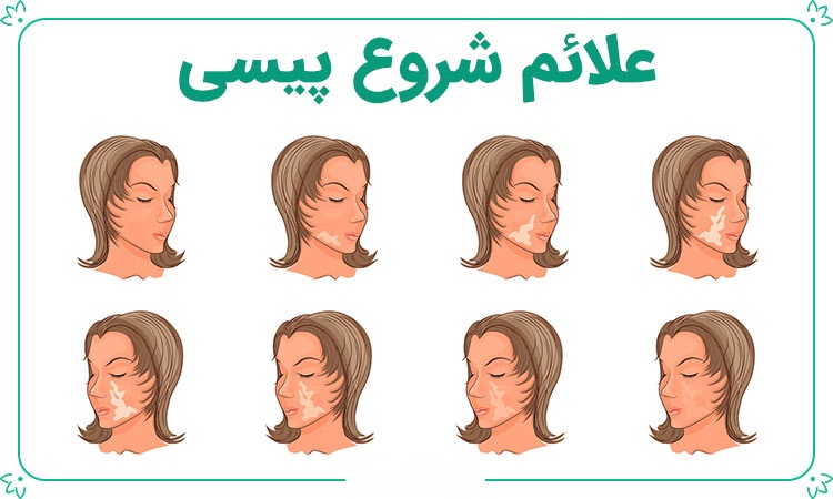 معرفی بیماری پیسی و بررسی علل و راه های درمان در پامیشا