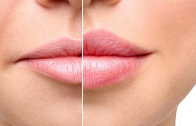 بررسی تفاوت های تزریق فیلر و ژل