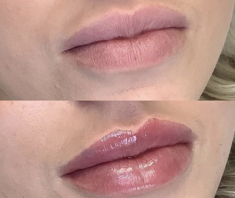 بررسی تفاوت های تزریق فیلر و ژل در پامیشا