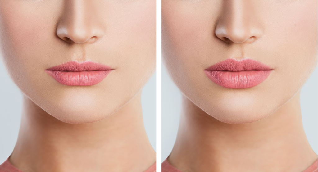 بررسی تفاوت های تزریق فیلر و ژل در پامیشا