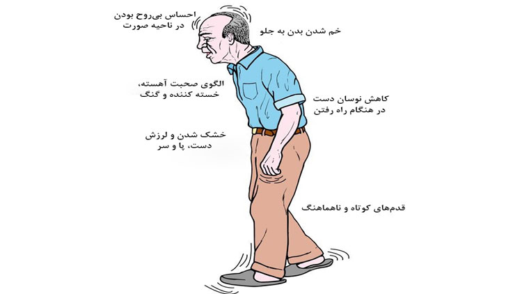 بیماری پارکینسون؛ نشانه‌ها، علائم، پیشگیری و درمان آن در پامیشا