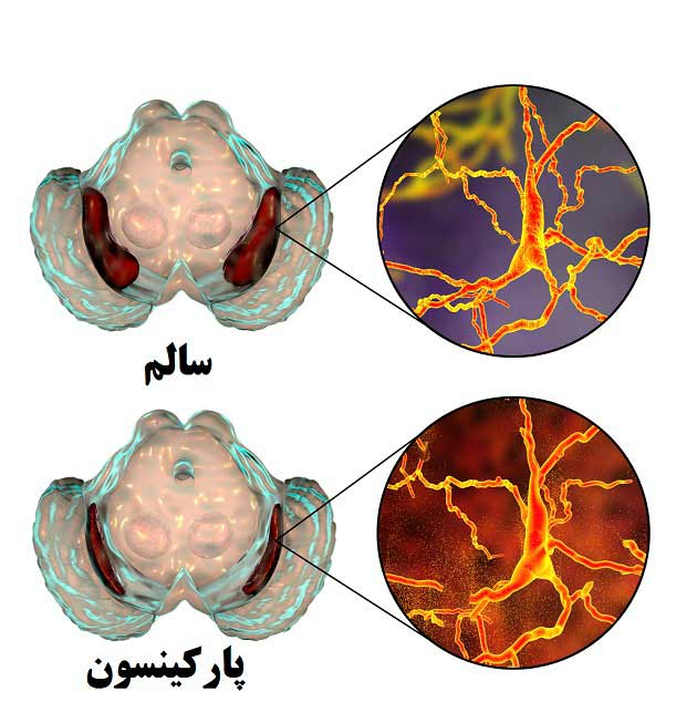 بیماری پارکینسون؛ نشانه‌ها، علائم، پیشگیری و درمان آن در پامیشا
