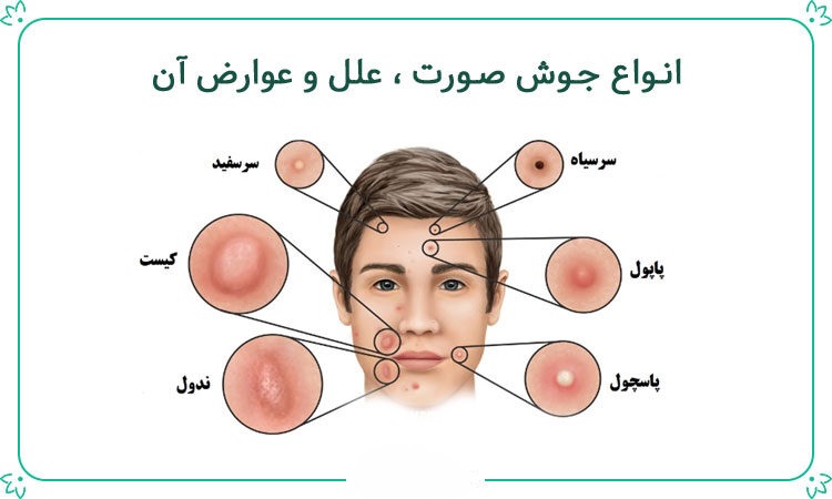 دانستنی های جوش صورت و معرفی درمان های فوری در پامیشا