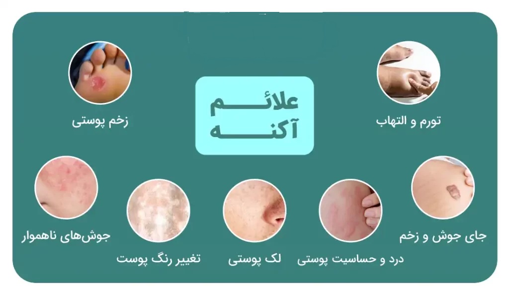 دانستنی های جوش صورت و معرفی درمان های فوری در پامیشا