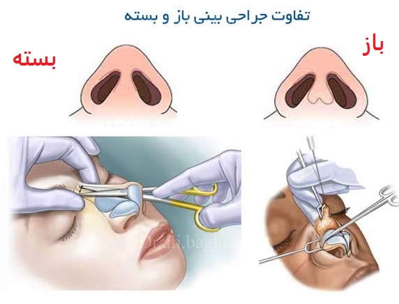 زیبایی بینی و معرفی انواع آن ئر پامیشا