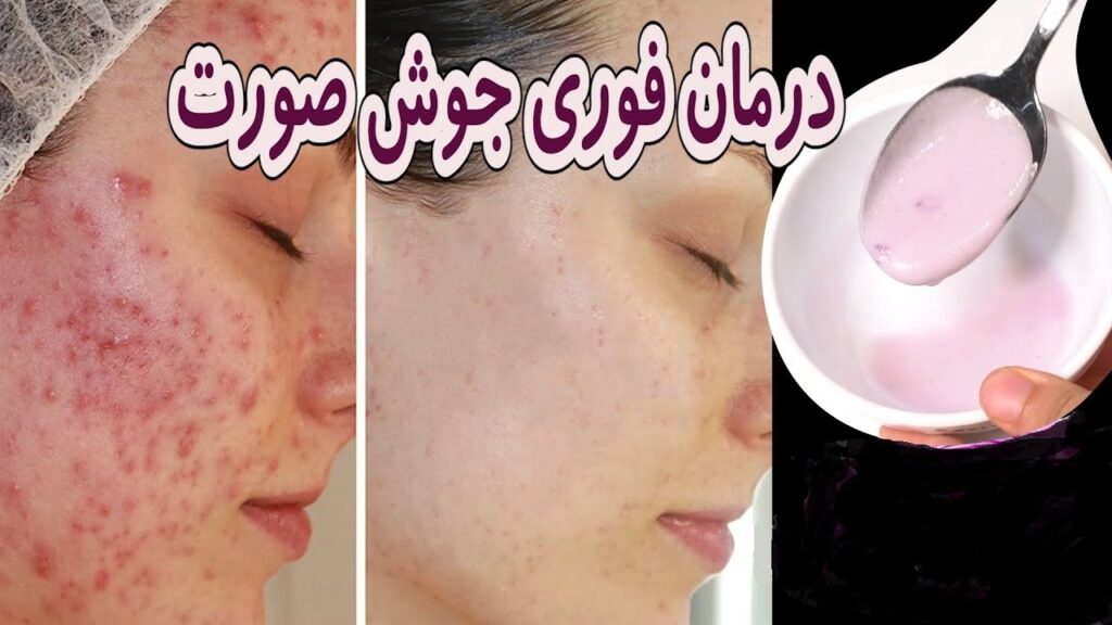 دانستنی های جوش صورت و معرفی درمان های فوری در پامیشا