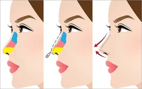 زیبایی بینی و معرفی انواع آن ئر پامیشا